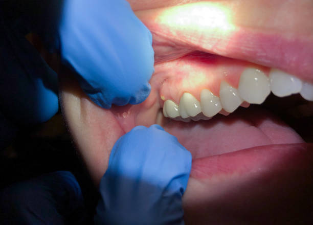 Best Broken or Cracked Tooth Emergency Dentist in North Babylon, NY