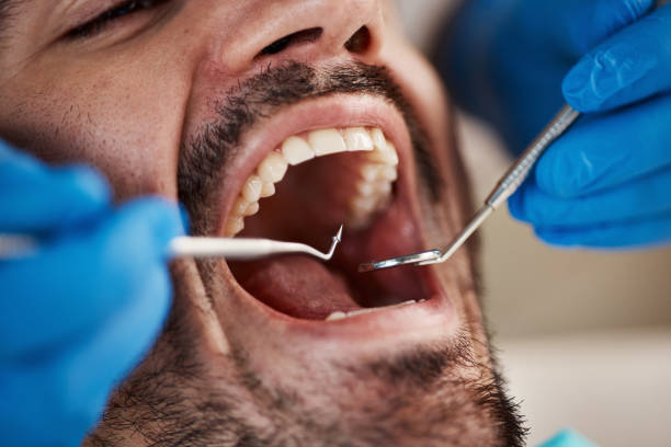 Best Emergency Dentist for Lost Fillings or Crowns in North Babylon, NY